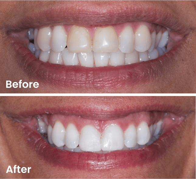 Whitening Before After